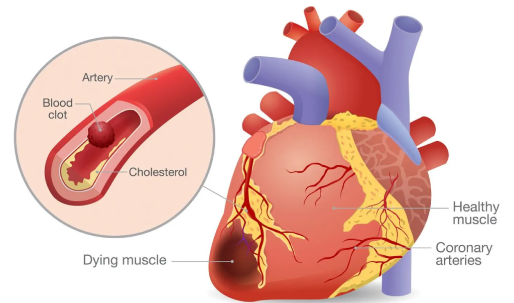 Heart disease, its causes, risk, and prevention learn in detail. 